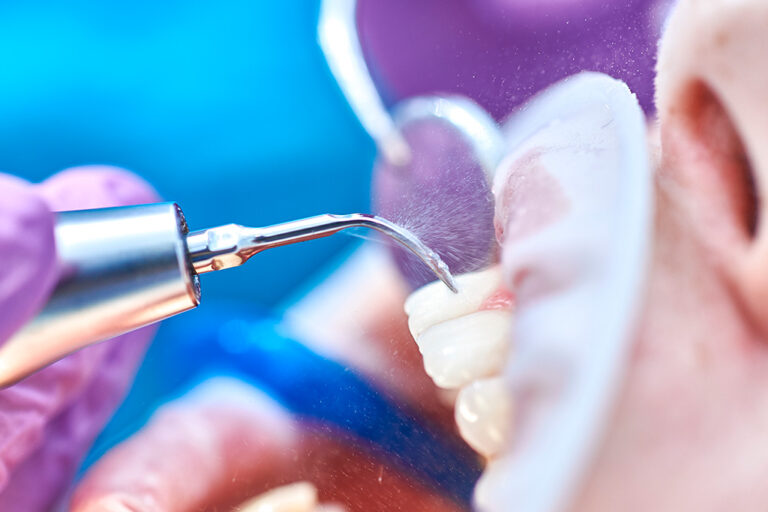 Ultrassom Cavitador Odontológico: mais eficiência, menos desconforto no consultório